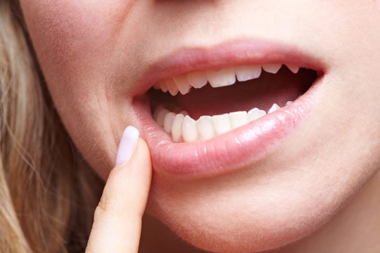 Ağız İçinde Oluşan Yaralar, Diş Eti Kanamaları Birçok Ciddi Hastalığın Belirtisi Olabili